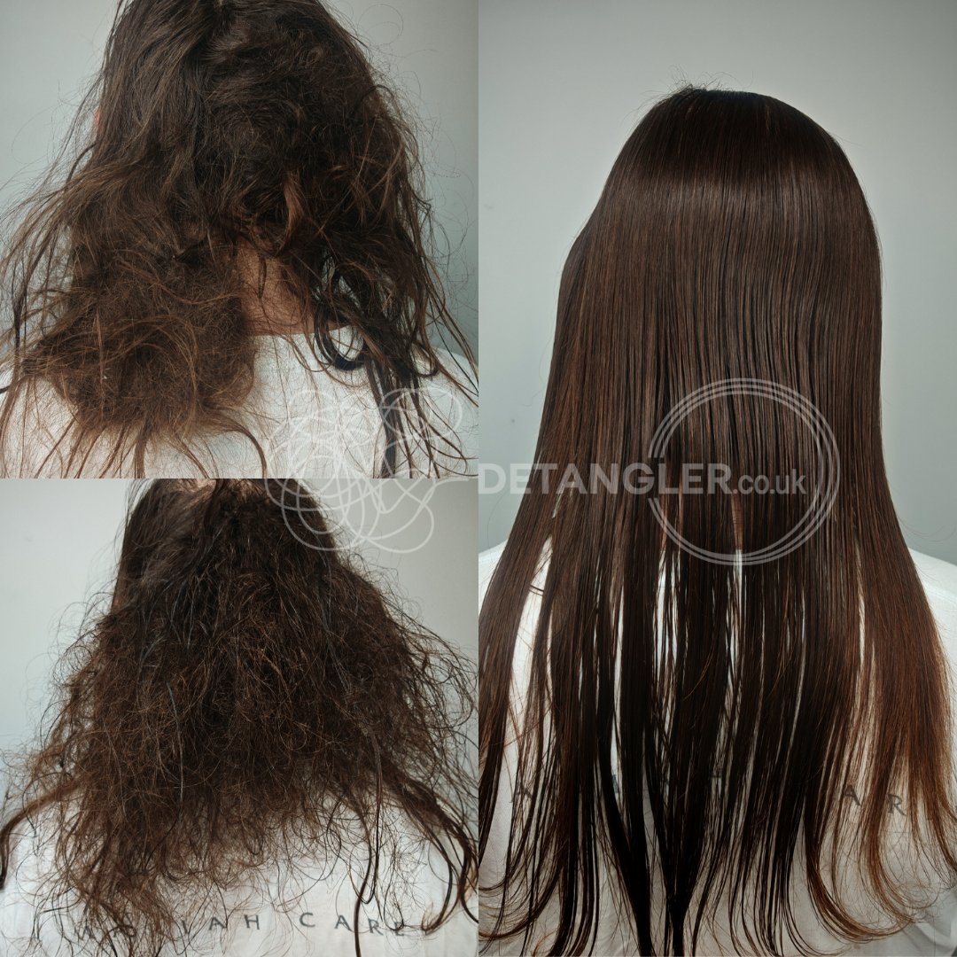 Long matted hair successfully detangled without scissors — documented case 5