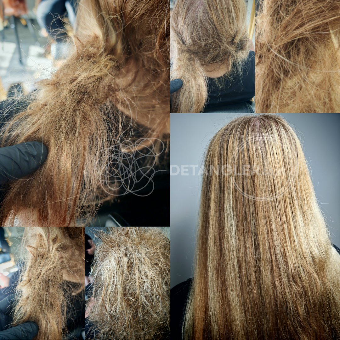 Medical matted hair recovery — post-hospitalisation case — documented case 12
