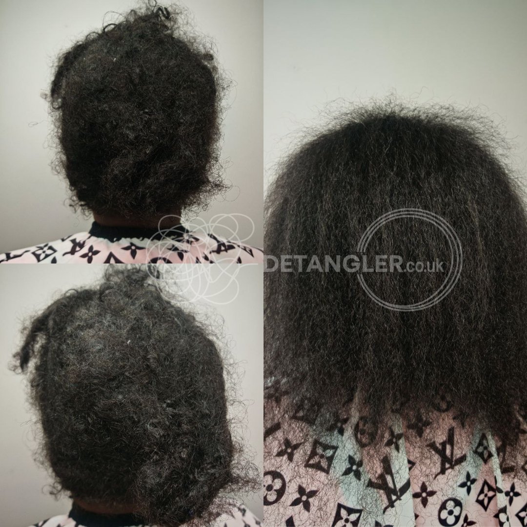 Depression-related matted hair restoration — MHFA certified specialist — documented case 13