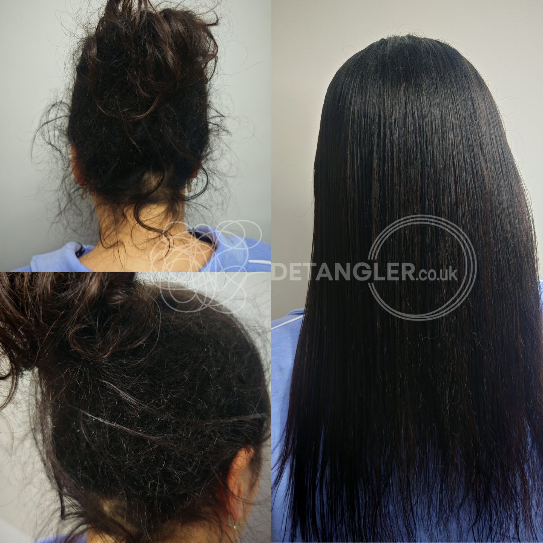 Long matted hair successfully detangled without scissors — documented case 25