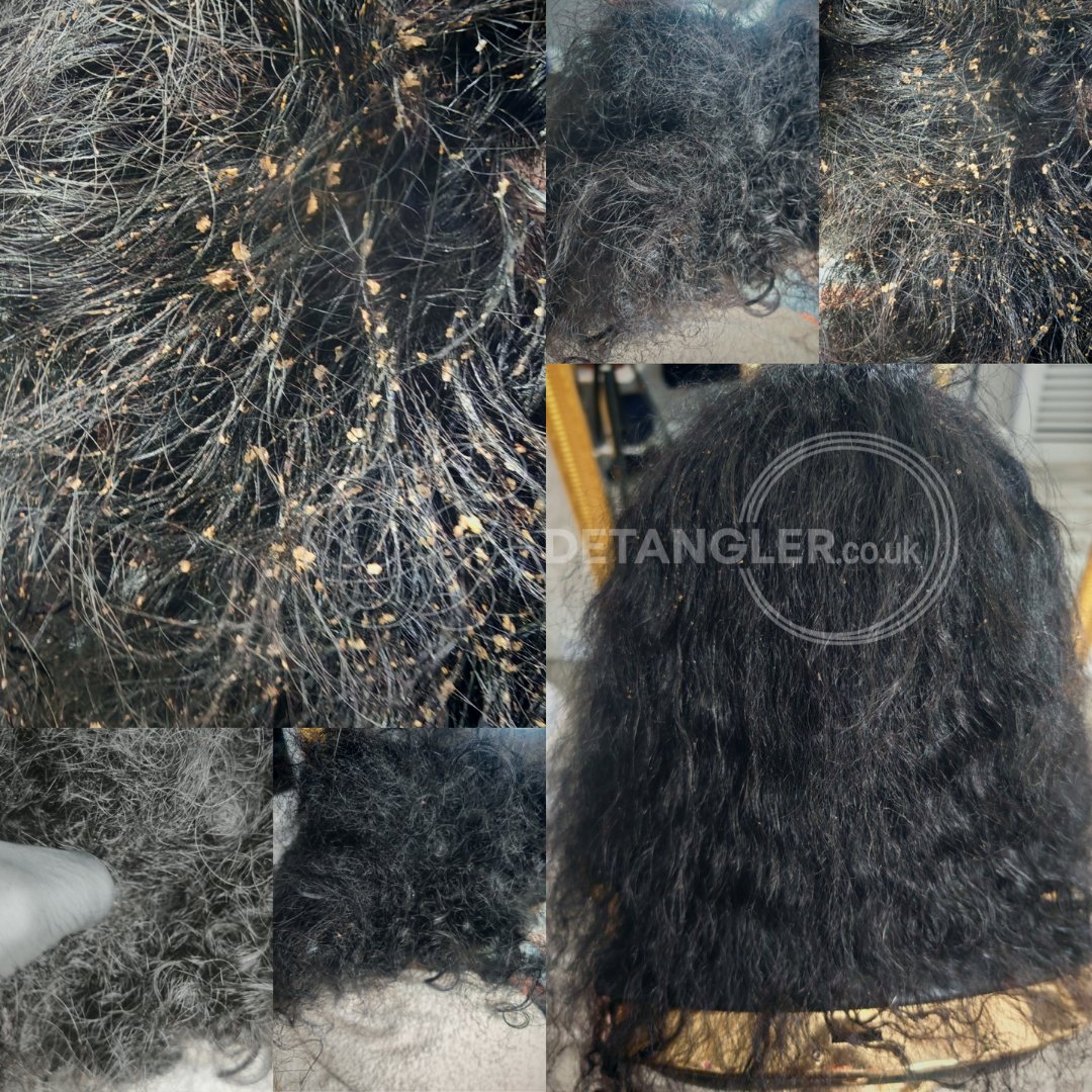 Curly matted hair restored to healthy condition without cutting — documented case 27