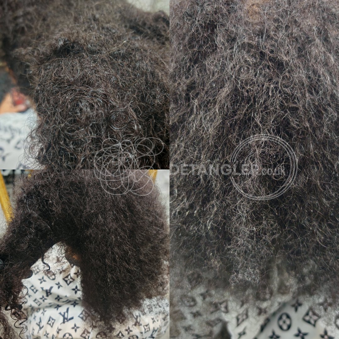 Medical matted hair recovery — post-hospitalisation case — documented case 32