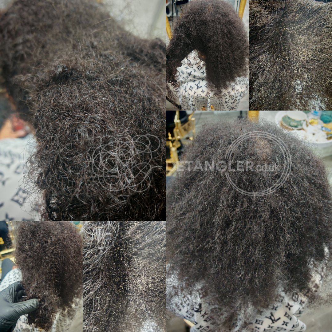 Depression-related matted hair restoration — MHFA certified specialist — documented case 33