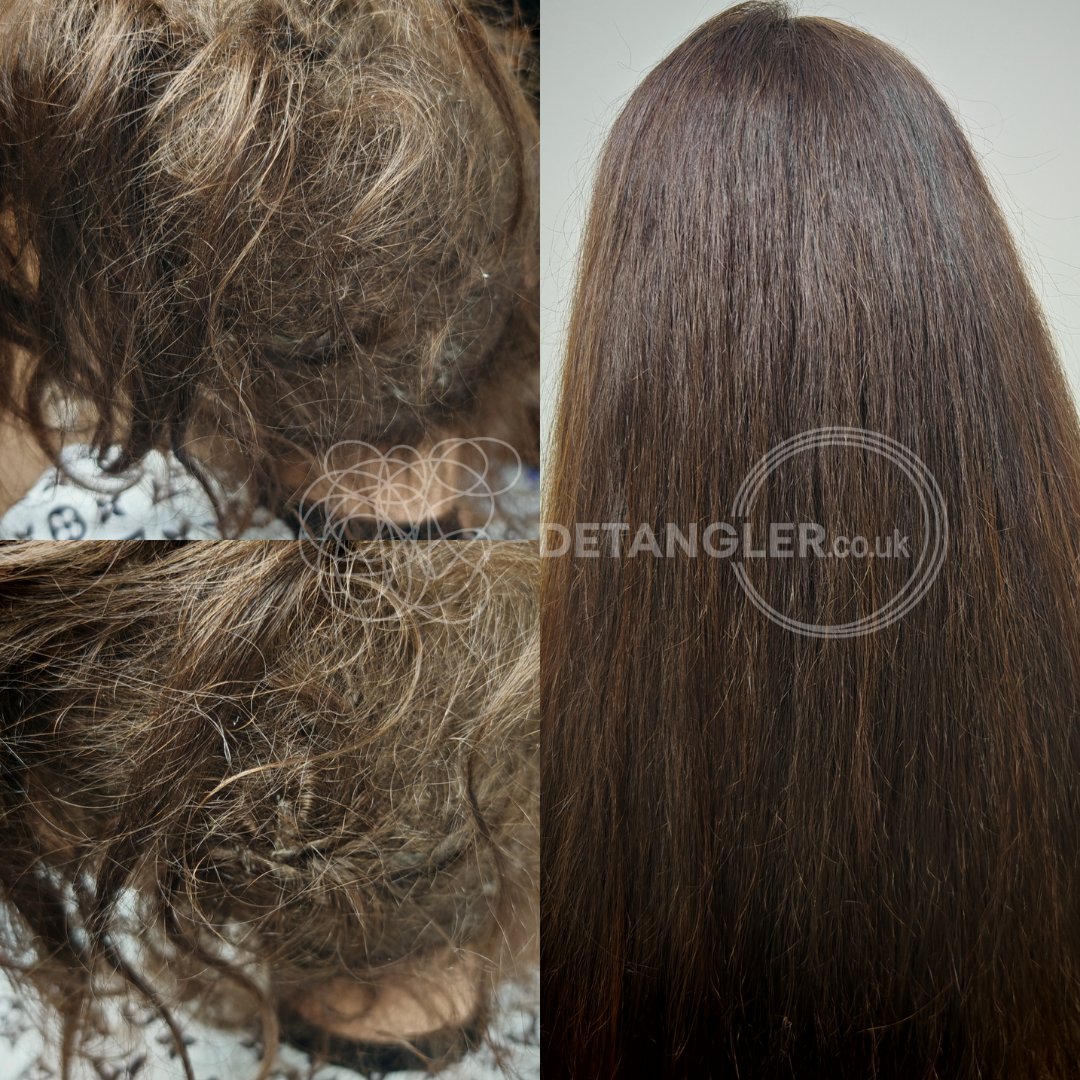 Long matted hair successfully detangled without scissors — documented case 45