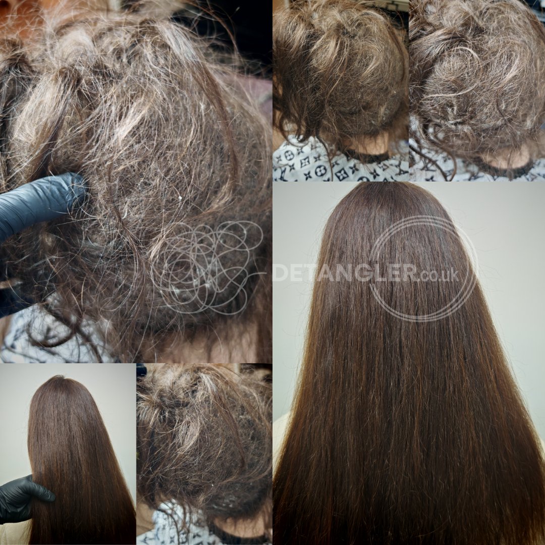 Postpartum matted hair transformation — Detangler London case study — documented case 46