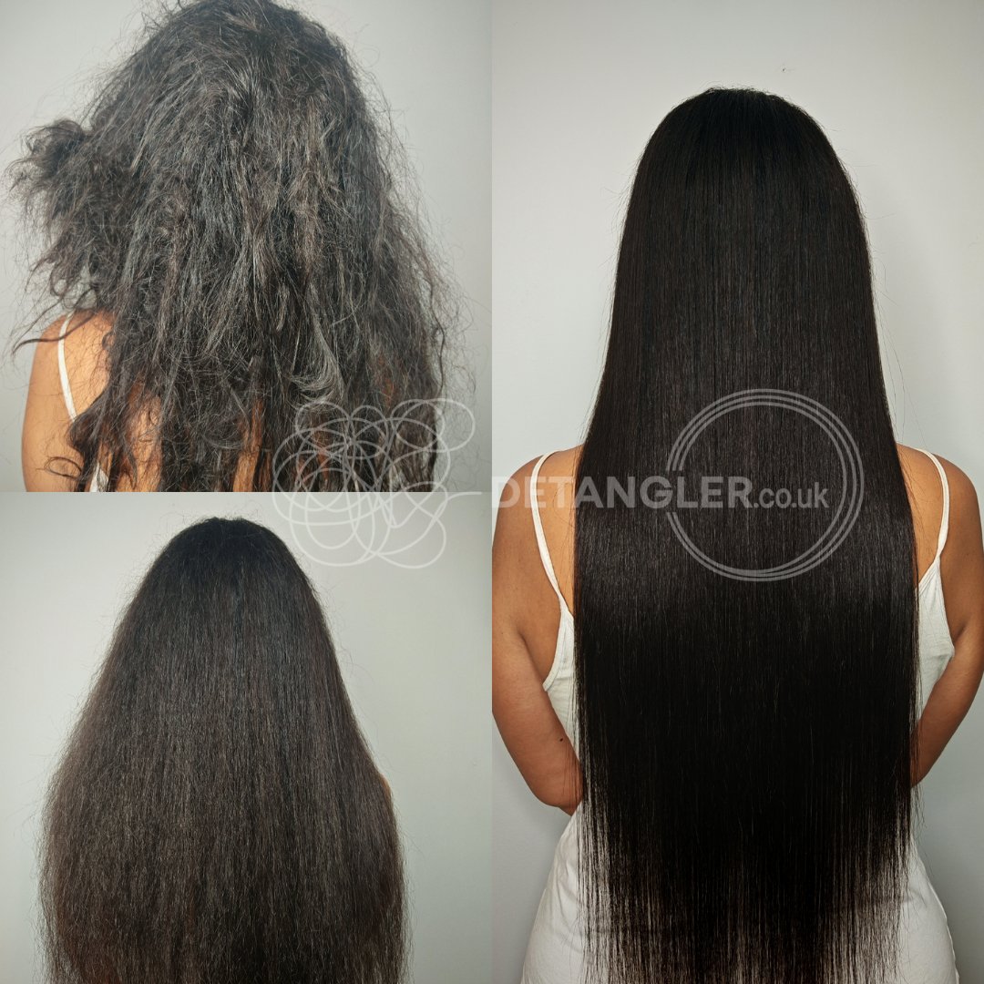 Medical matted hair recovery — post-hospitalisation case — documented case 52