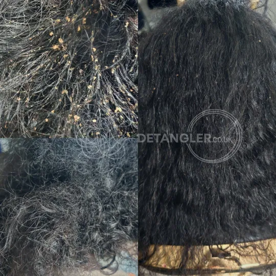 Severe matting treated without cutting by a certified matted hair specialist