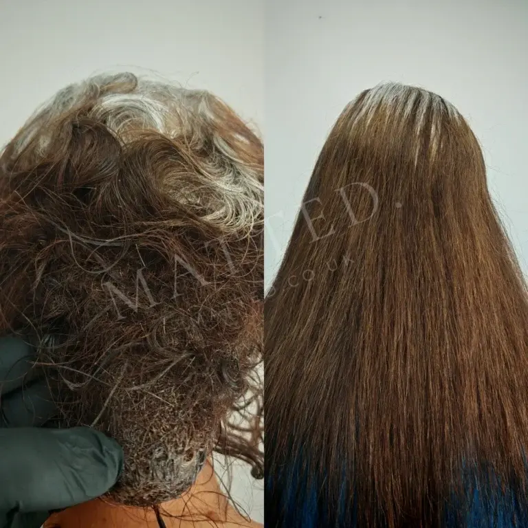 Severely matted straight hair before treatment and the same head after, side by side