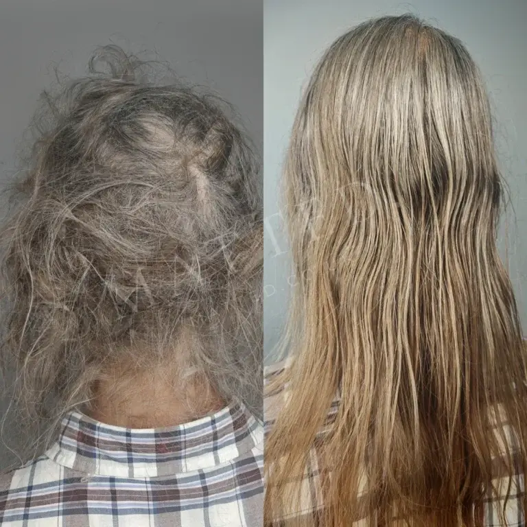 Severely matted straight hair cleared without shaving any of it off