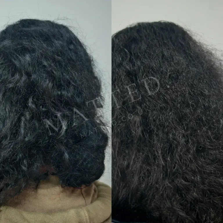 Wavy hair matted after a hospital stay, opened gently with no pull on the scalp