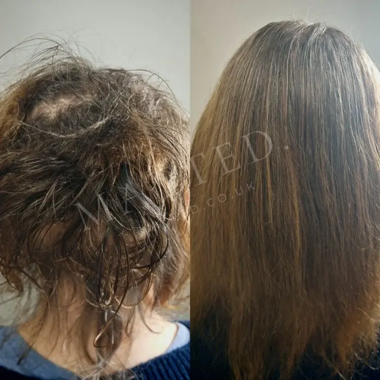 Matted straight hair on an elderly client, cleared slowly and without discomfort