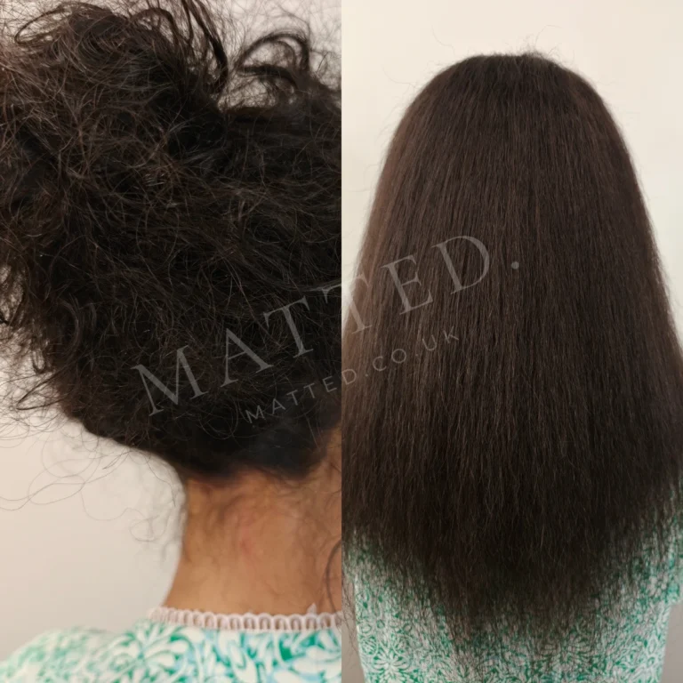 Severely matted straight hair restored by hand rather than with scissors
