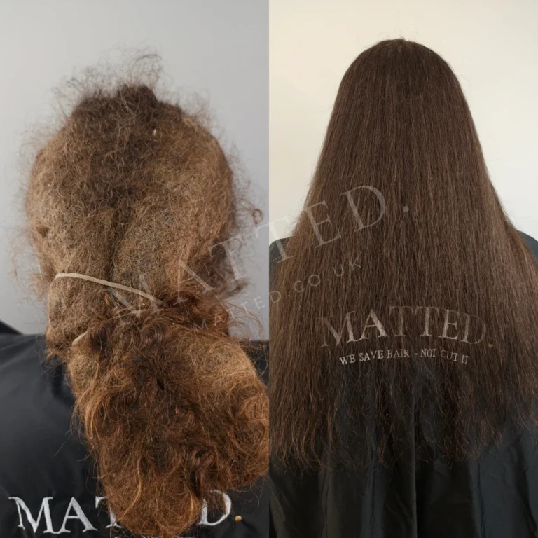 Severely matted straight hair lifted clear in a single session