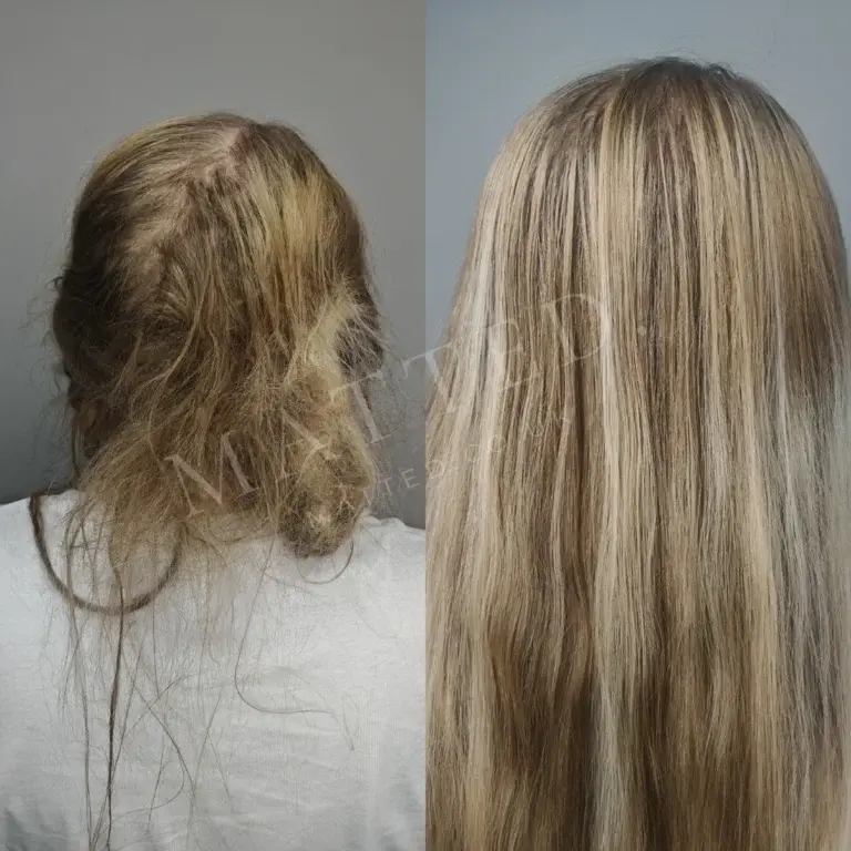 Severely matted straight hair restored strand by strand, with no length removed